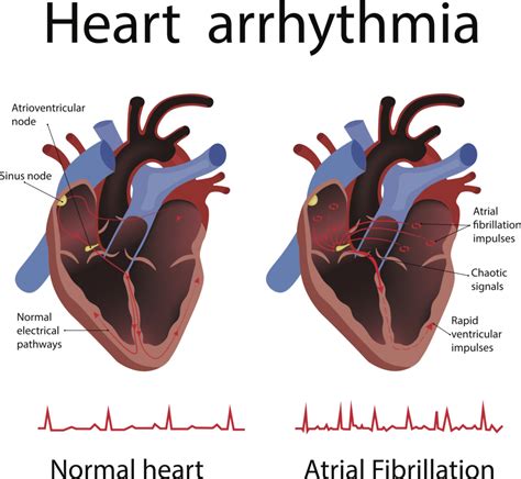 electrophysiology arrhythmia near belmont|Electrophysiologic Testing .